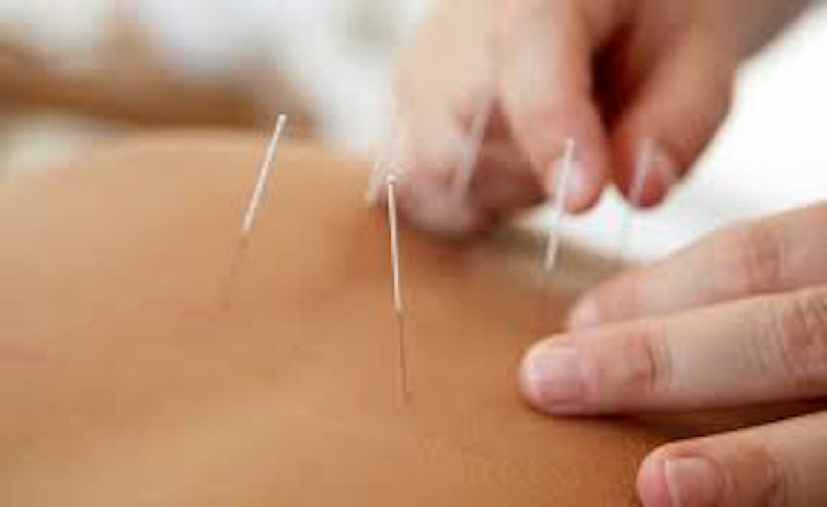Different health issues that service related to Acupuncture in Morris
