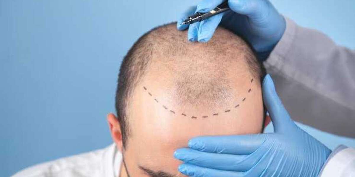 Hair Transplant to Lower Hairline: Reclaiming Your Confidence